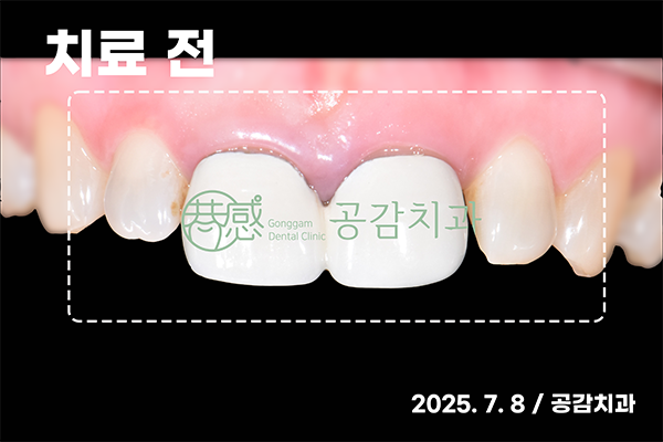 치료 전 Contrast — 치아 형태·경계 확인