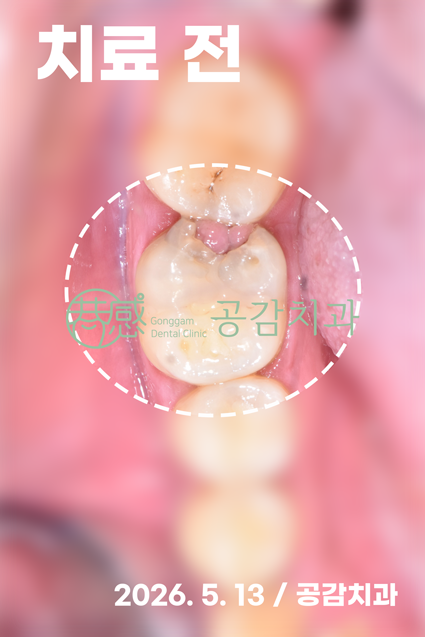 치료 전 구강사진 — 충치·파절·잇몸 증식