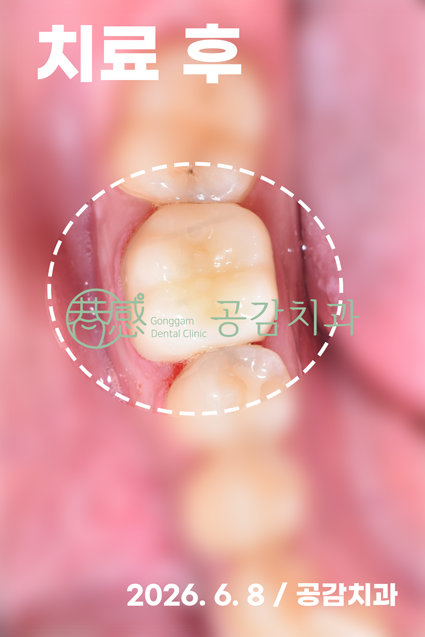치료 후 구강사진 — 크라운 수복 완료